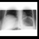 Ileus, small bowel: X-ray - Plain radiograph